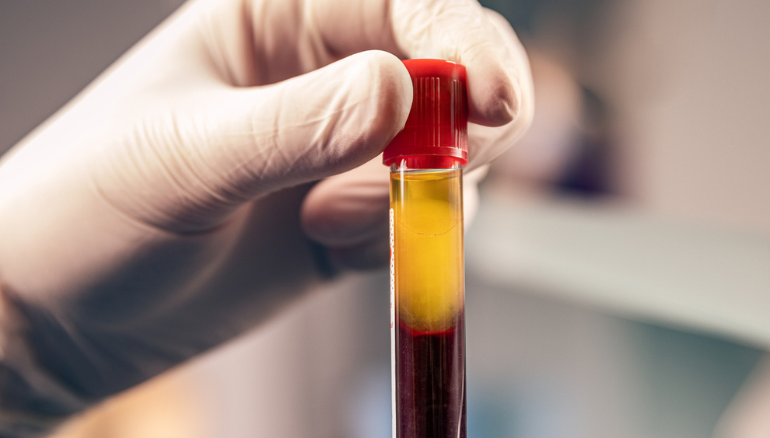 Can Platelet Rich Plasma PRP Therapy Treat Erectile Dysfunction