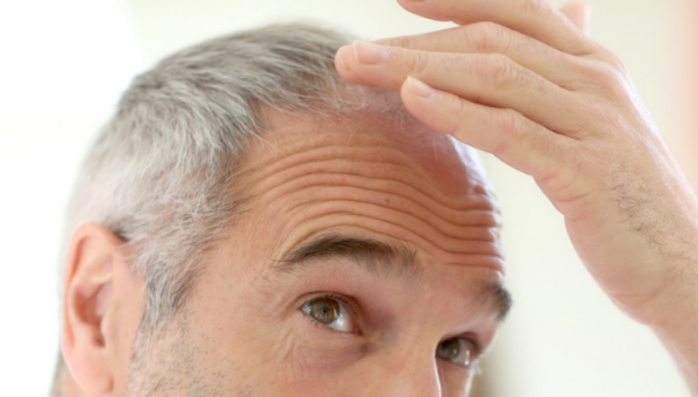 Male Hair Loss Facts